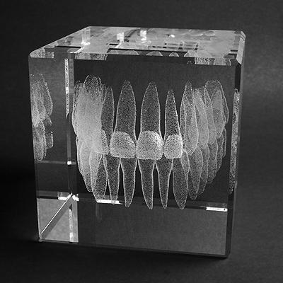 Seitenansicht Gebiss mit Veneers