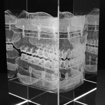 Galvano-Implantat-Steg-Prothese