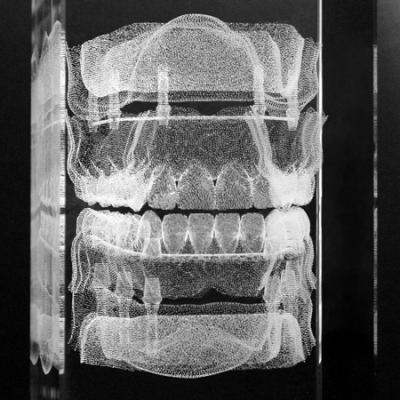 Galvano-Implantat-Steg-Prothese